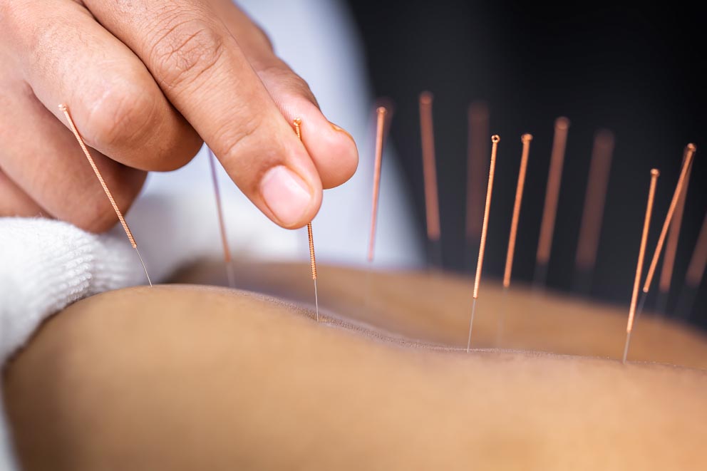 Die Akupunktur ist ein Heilverfahren aus der traditionellen chinesischen Medizin.